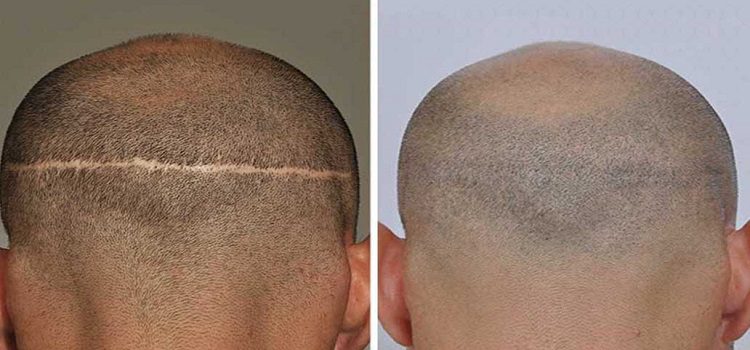 Follicular unit transplantation