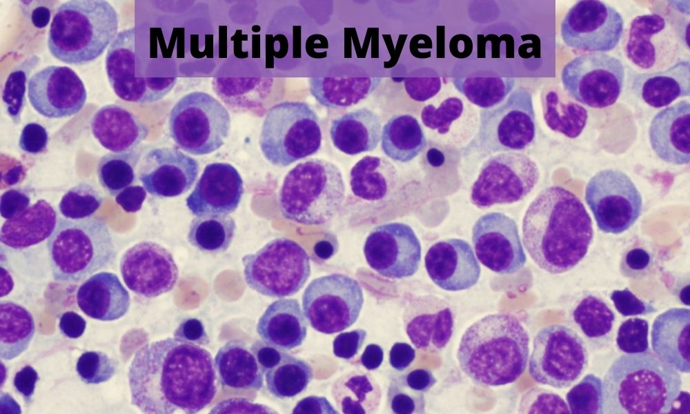 Multiple Myeloma