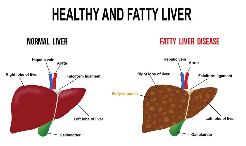 Everything You Need To Know About Fatty Liver Disease