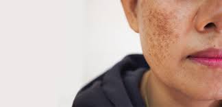 Hyperpigmentation