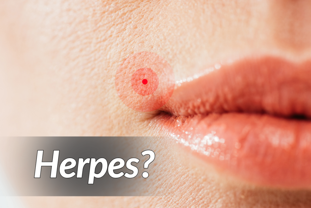 Herpes