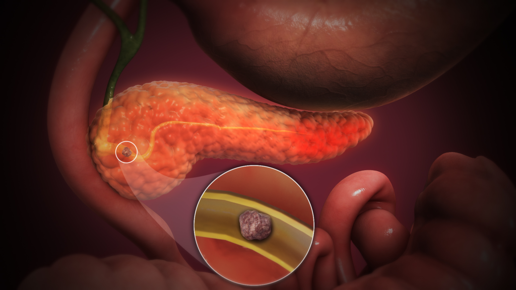Pancreas Infection Treatment